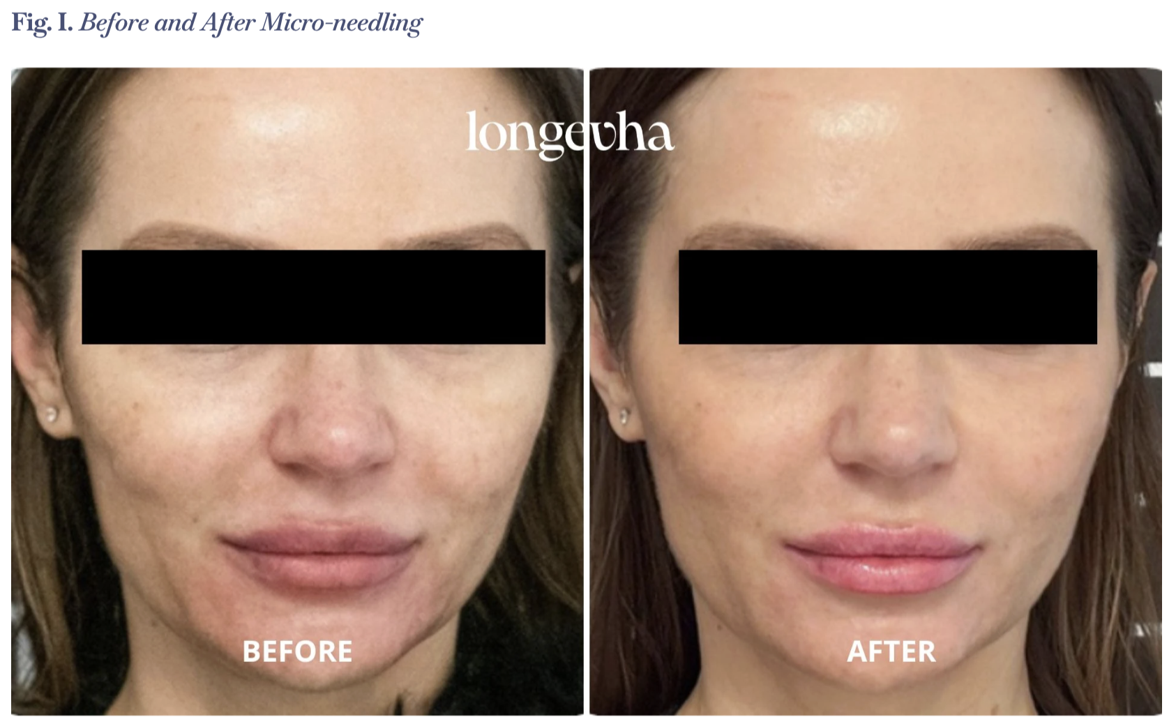 longevha skin booster before and after