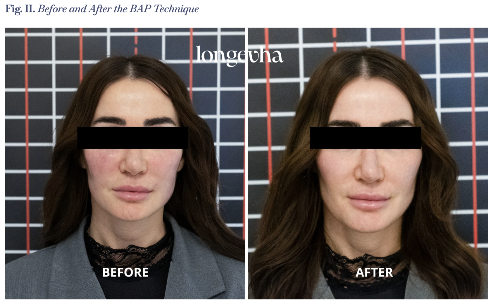 longevha skin booster before and after