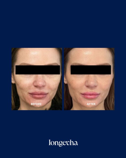 A subtle change. A visible difference ✨
LongevHA focuses on supporting skin quality, hydration and a more refreshed-looking complexion - enhancing the skin without changing the way you look.
Natural-looking results, designed to work with your skin.
Follow us for more treatment journeys, practitioner insights and the science behind LongevHA.
#longevha #longevity #skinhydration #aestheticinnovation